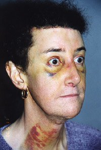 7 days post-op