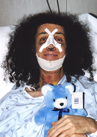 4 Days Post-op with Karen&rsquo;s Teddy Bear